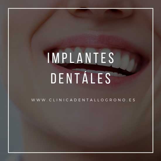 Especialistas en implantología dental en Logroño
