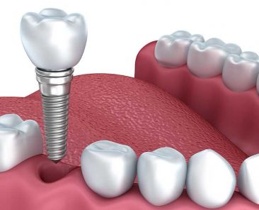 preguntas-implantes-dentales
