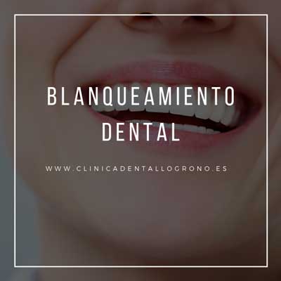 Tratamiento de blanqueamiento dental en clínica dental de Logroño
