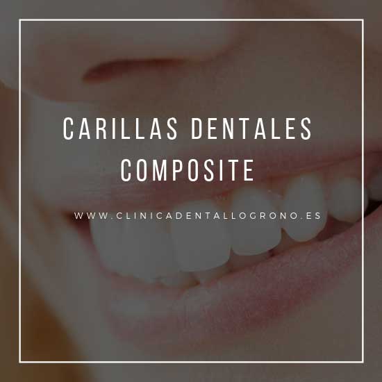 Carillas dentales de composite en Logroño